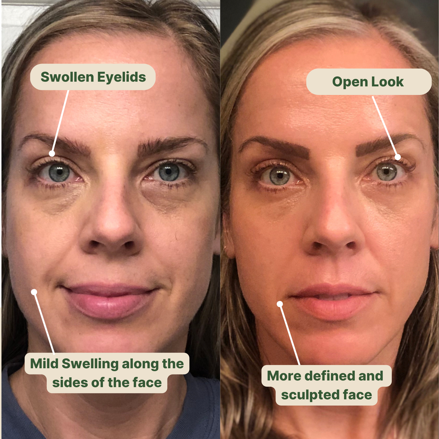 MyOfera™ Lymphatic Wellness Drops